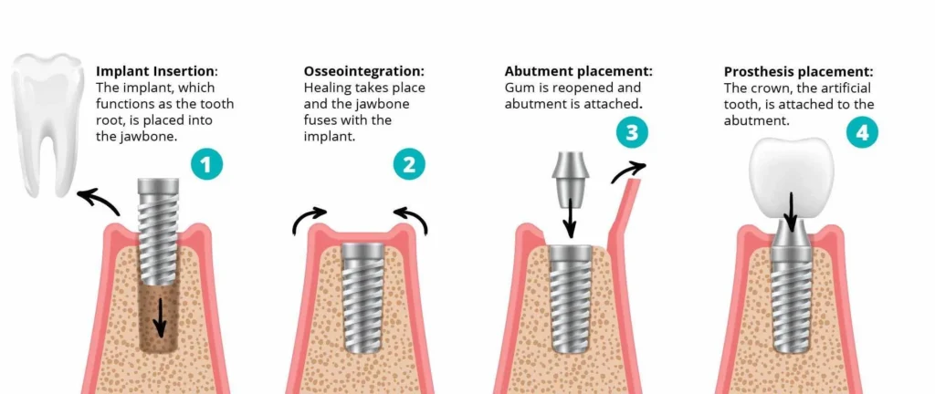 Best Dentist in Surat Vesu 	Dental Clinic in Surat Vesu	Dental Implants in Surat Vesu