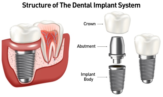 Best Dentist in Surat Vesu 	Dental Clinic in Surat Vesu	Dental Implants in Surat Vesu