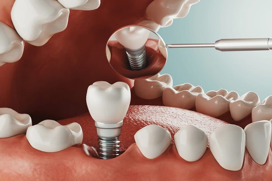 Best Dentist in Surat Vesu 	Dental Clinic in Surat Vesu	Dental Implants in Surat Vesu