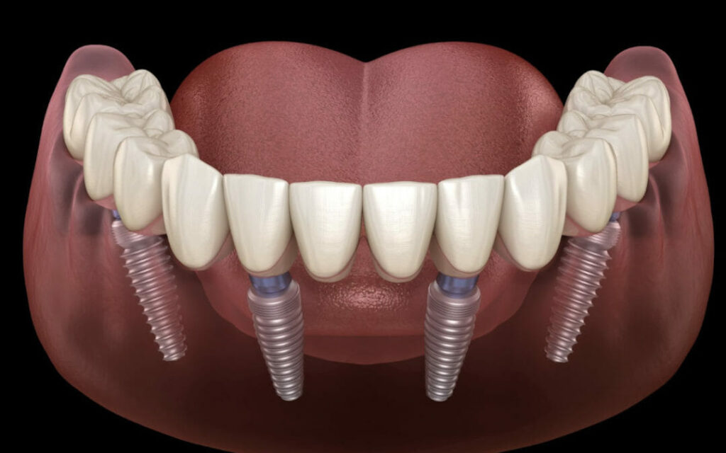 Best Dentist in Surat Vesu Dental Clinic in Surat Vesu Dental Implants in Surat Vesu