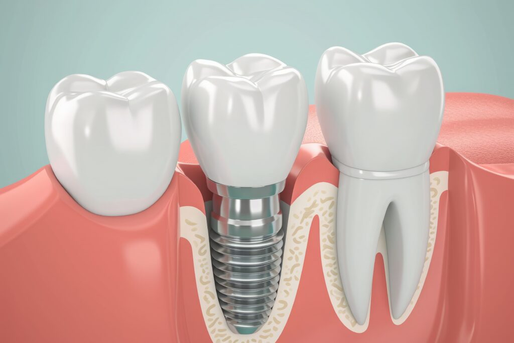 Best Dentist in Surat Vesu Dental Clinic in Surat Vesu Dental Implants in Surat Vesu