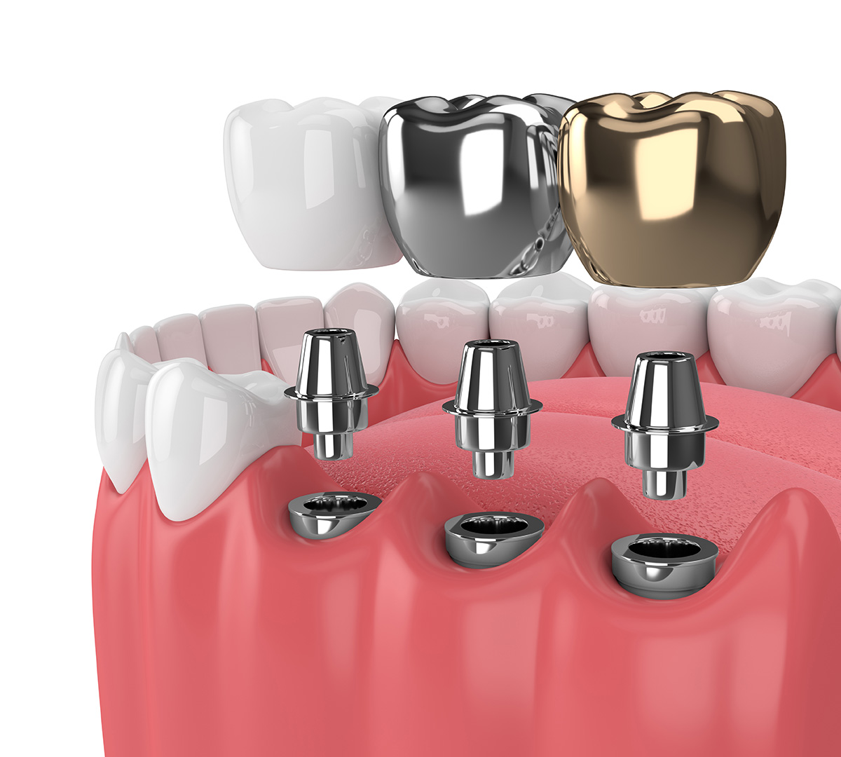 Best Dentist in Surat Vesu Dental Clinic in Surat Vesu Dental Implants in Surat Vesu