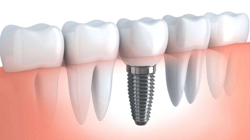 Best Dentist in Surat Vesu Dental Clinic in Surat Vesu Dental Implants in Surat Vesu