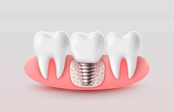 Best Dentist in Surat Vesu Dental Clinic in Surat Vesu Dental Implants in Surat Vesu