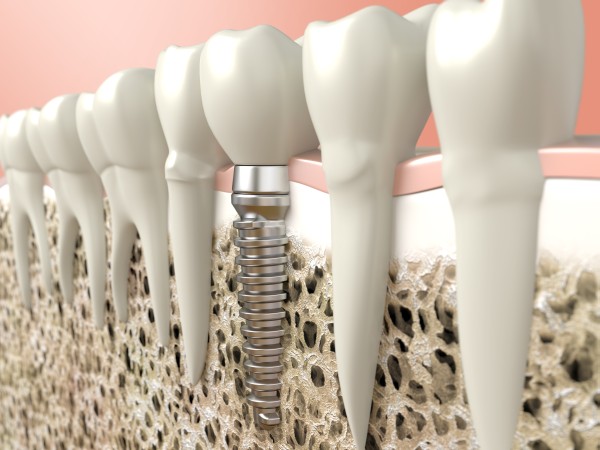 Best Dentist in Surat Vesu Dental Clinic in Surat Vesu Dental Implants in Surat Vesu