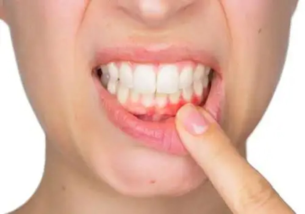 best dentist in Surat Vesu, dental clinic in Surat Vesu, pyorrhea treatment in Surat, gum disease treatment, dental implants in Surat Vesu, smile designing in Surat, root canal treatment in Surat, invisible aligners in Surat, best dental care in Surat, teeth whitening in Surat, dental veneers in Surat, cosmetic dentistry in Surat, laser gum treatment, painless root canal, missing teeth solutions, orthodontic treatment in Surat, professional dental cleaning, bleeding gums treatment, gum recession treatment, dental bridges in Surat, Dr. Panseriya’s Dental & Implant Clinic