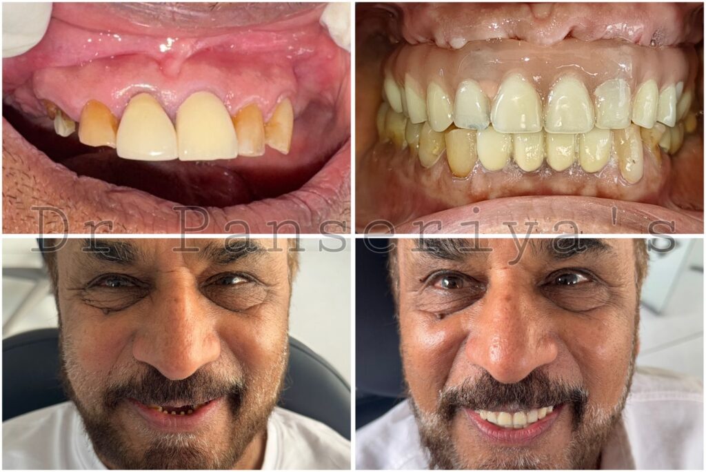 Dental implants in Surat Vesu, best dental clinic in Surat Vesu, Dr. Panseriya’s Dental & Implant Clinic, smile transformation Surat, Solly Adam dental treatment, dental implant specialist Surat, painless dental implants, celebrity dental care Surat, advanced dental technology Surat, quick dental procedure Surat, customized dental implants, dental consultation Surat Vesu, natural-looking dental implants, top dentist in Surat Vesu, oral health restoration, esthetic dental treatment Surat, dental clinic for implants, implant dentistry Surat
